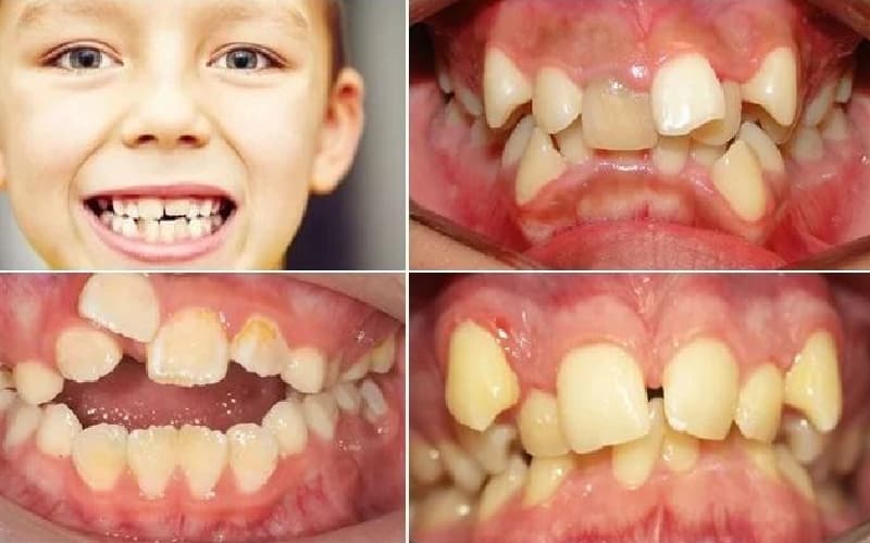 thời gian niềng răng bao nhiêu