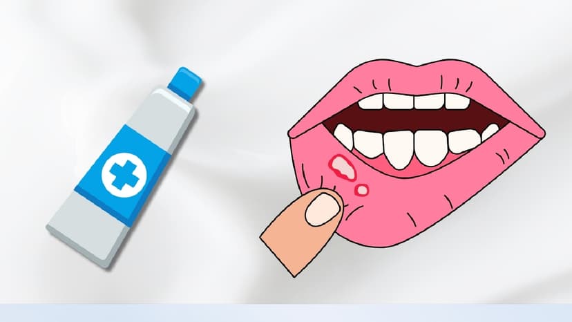 Thuốc bôi nhiệt miệng: Sử dụng đúng cách