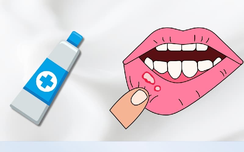 Thuốc bôi nhiệt miệng hiện nay