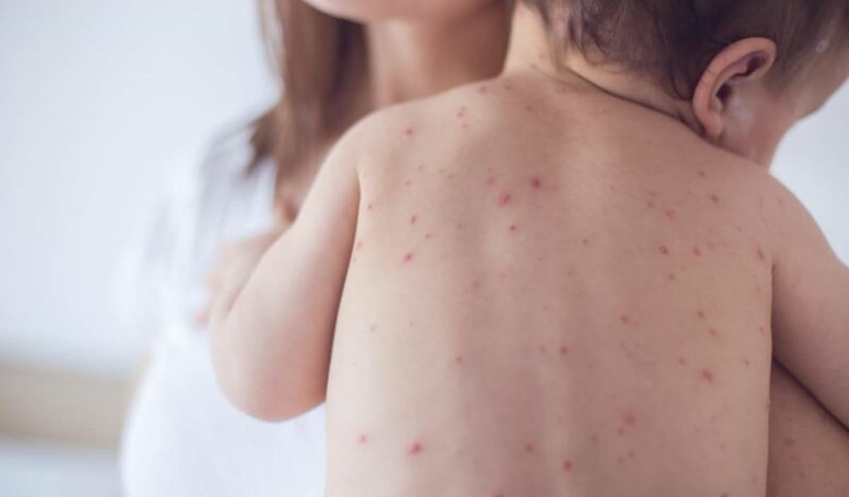 Thủy đậu kiêng gì để tránh biến chứng nguy hiểm