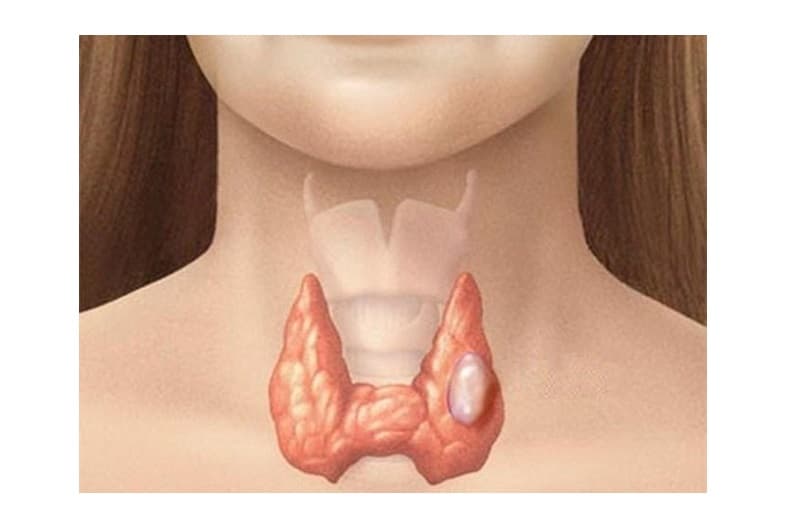 Phần lớn các khối u tuyến giáp được phát hiện đều mang tính chất lành tính và không tiến triển thành ung thư