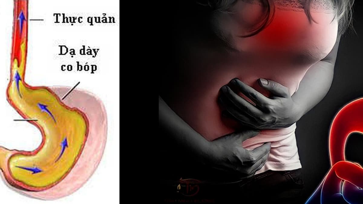 Trào ngược dạ dày: Hệ lụy lớn và cách xử trí hiệu quả