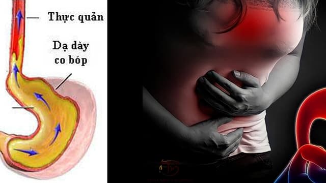 Trào ngược dạ dày: Hệ lụy lớn và cách xử trí hiệu quả