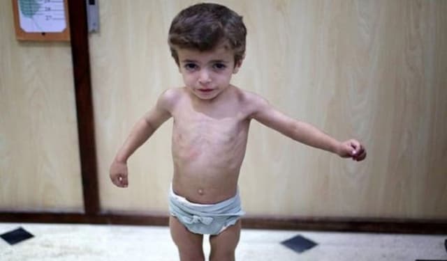 Nguy cơ tiềm ẩn khi trẻ biếng ăn còi cọc cha mẹ thường bỏ qua