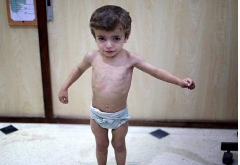 Trẻ biếng ăn còi cọc hiện nay là tình trạng phổ biến khiến nhiều phụ huynh lo lắng.