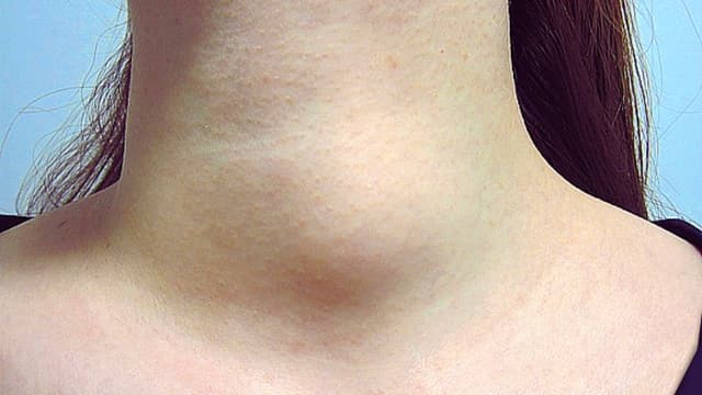 Nhận biết sớm triệu chứng u tuyến giáp lành tính