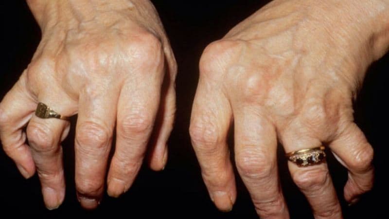 Hậu quả của tình trạng viêm đa khớp