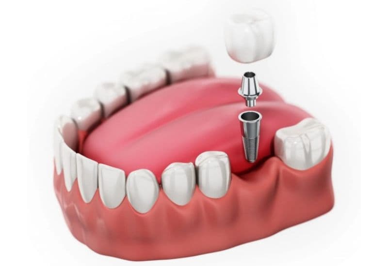 Giải pháp trồng răng hàm mang lại hiệu quả thẩm mỹ vượt trội cho người mất răng.