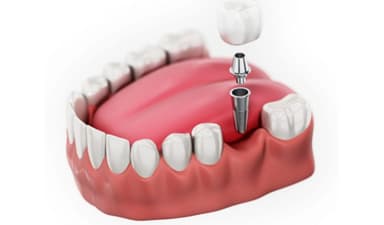 Trồng răng hàm: Chi phí và các phương pháp phổ biến hiện nay