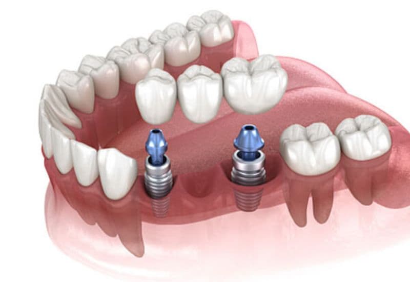 Trồng răng sứ là kỹ thuật phục hình răng hư hỏng hoặc mất bằng răng giả bằng sứ.