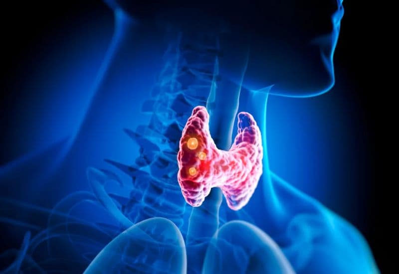 U tuyến giáp lành tính là gì?