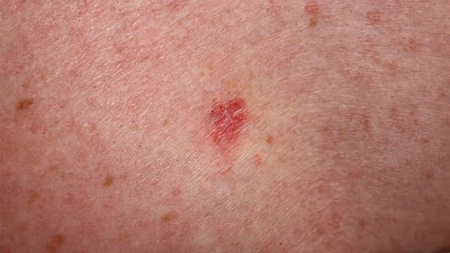 Ung thư biểu mô và những điều cần biết