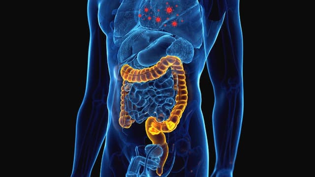 Ung thư đại tràng di căn phổi – Phương hướng điều trị