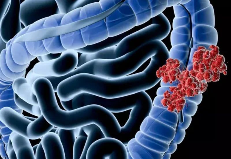 Ung thư đại tràng di căn phổi có chữa được không?