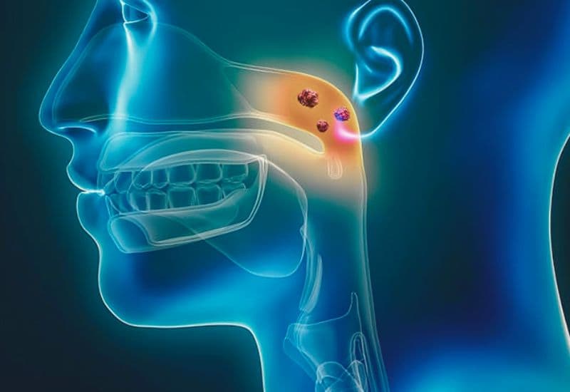 Ung thư vòm họng là gì?