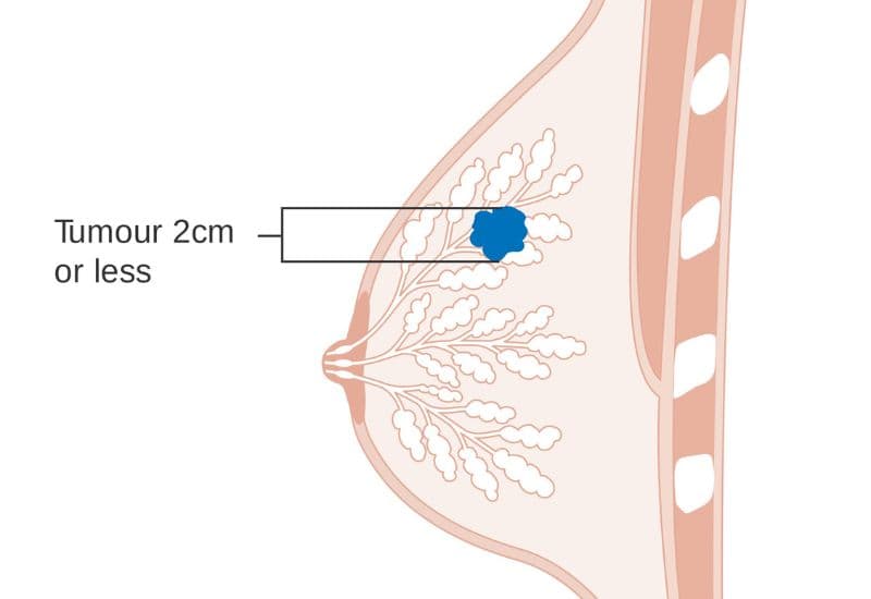 Nhận biết ung thư vú giai đoạn đầu và tầm quan trọng của việc phát hiện sớm