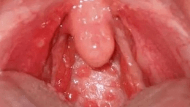 Viêm họng hạt – Thông tin và cách điều trị