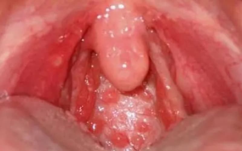 Tìm hiểu về Viêm họng hạt