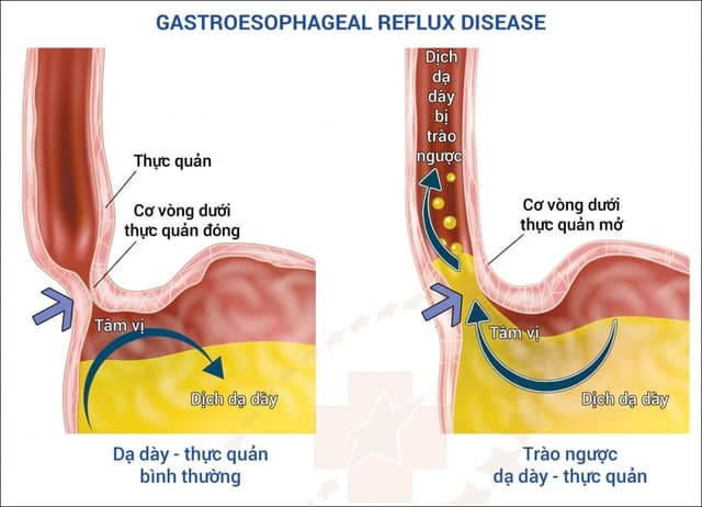 Viêm thực quản độ A: Hiểu đúng để điều trị hiệu quả