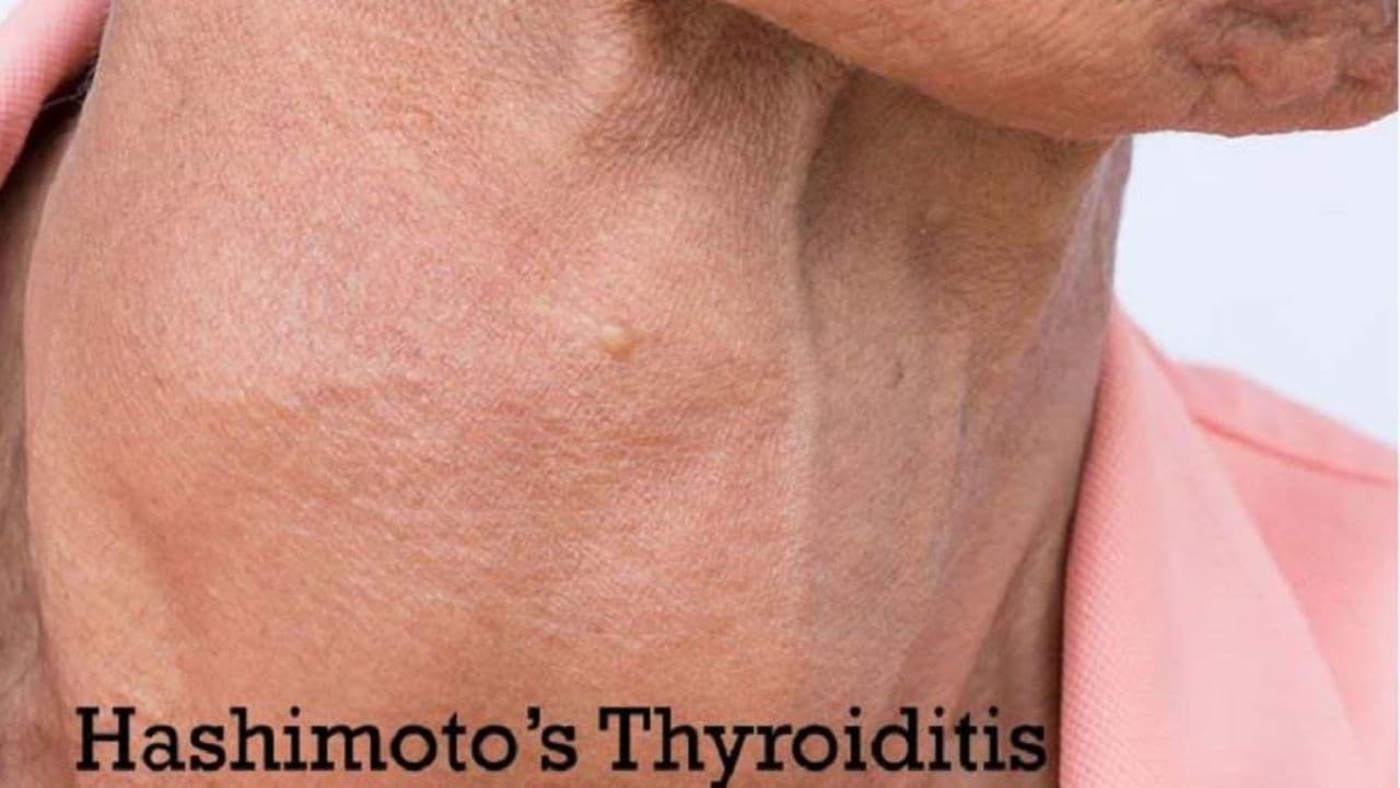 Bệnh viêm tuyến giáp Hashimoto, còn được gọi là Hashimoto's thyroiditis, là một bệnh tự miễn