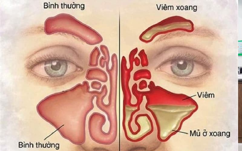 Viêm xoang dị ứng là gì