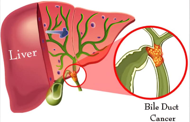Ung thư đường mật tại rốn gan có 8 giai đoạn khác nhau 
