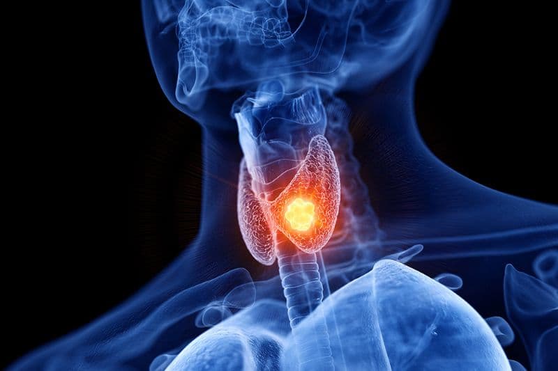 biểu hiện của u tuyến giáp lành tính