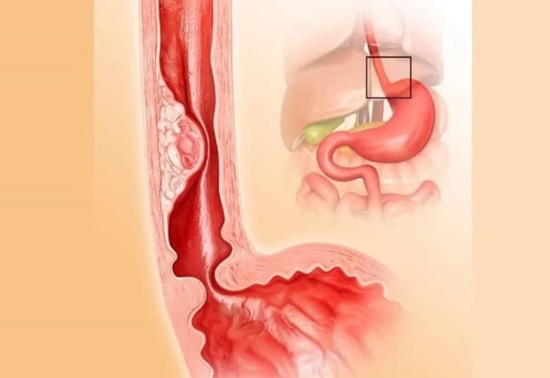 Viêm thực quản là một trong các bệnh lý gây nuốt vướng