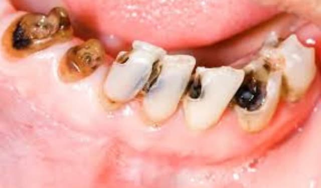 Nguyên nhân và dấu hiệu cảnh báo sớm bệnh sâu răng