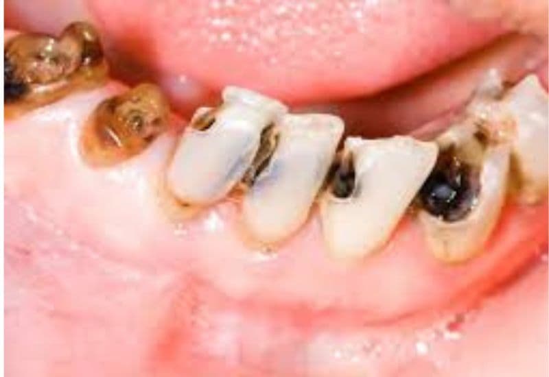 Bệnh sâu răng có thể tác động tiêu cực đến chất lượng cuộc sống hàng ngày.