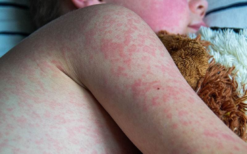 Bệnh sởi ở trẻ nhỏ biểu hiện như thế nào