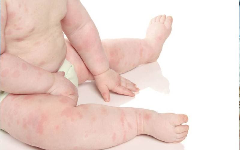 Nguyên nhân Bệnh sởi ở trẻ nhỏ