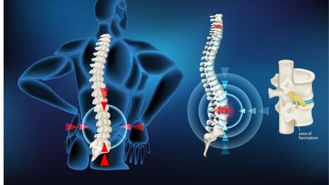 Nguyên nhân gây thoát vị đĩa đệm thắt lưng và cách điều trị