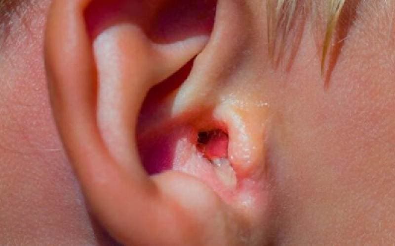 Bệnh viêm tai ngoài nguy hiểm không