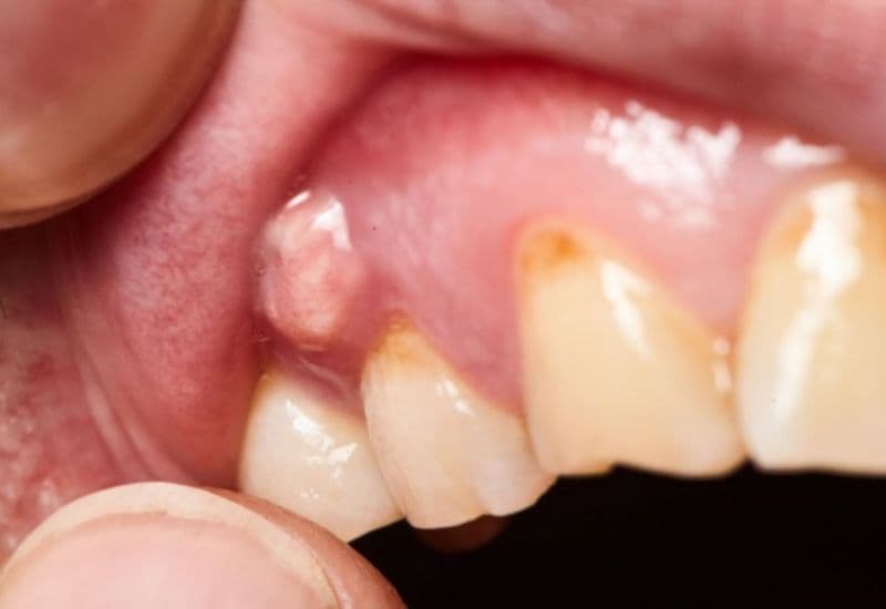 Bị đau răng sâu kéo dài có thể ảnh hưởng nghiêm trọng đến sức khỏe răng miệng về lâu dài.