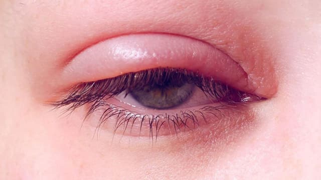 Biến chứng viêm bờ mi: Hiểu biết và phòng ngừa