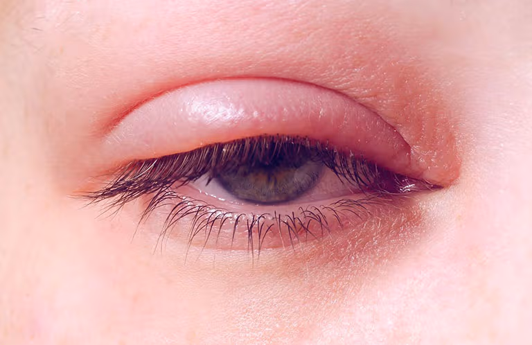 Viêm bờ mi là tình trạng viêm nhiễm xảy ra ở rìa mí mắt, thường do vi khuẩn, rối loạn tuyến bã nhờn.