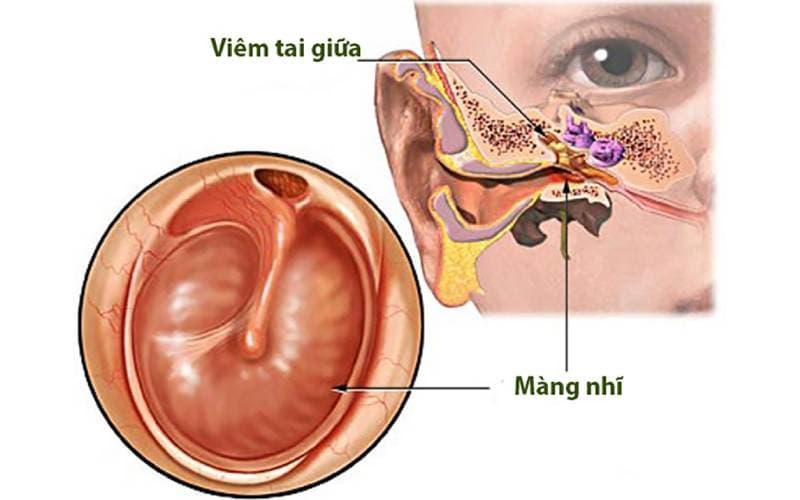 Biểu hiện viêm tai giữa ở trẻ có gì