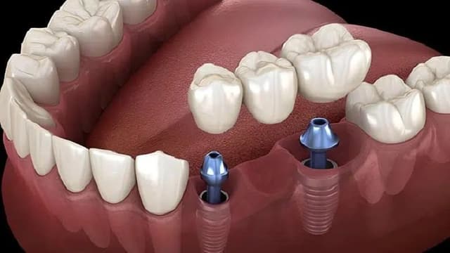 Bọc răng sứ Implant: Trồng răng bền vững chuẩn y khoa