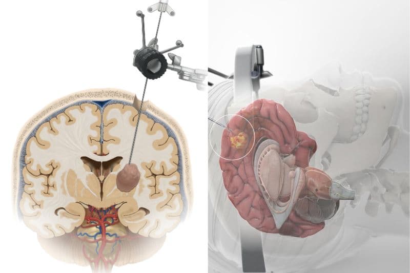 sinh thiết não định vị