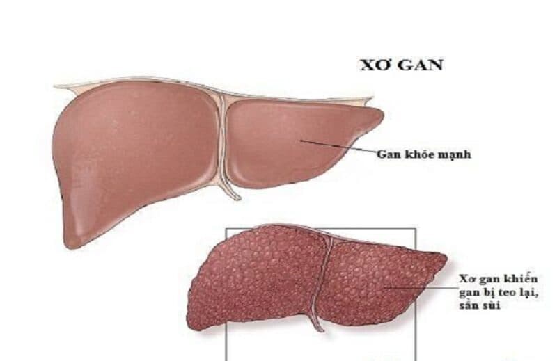 Xơ gan là giai đoạn cuối của nhiều bệnh lý gan mạn tính