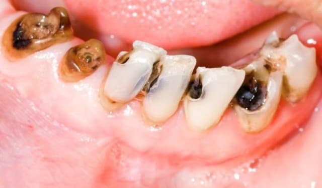 Chăm sóc răng bị sâu: Những sai lầm phổ biến bạn nên tránh