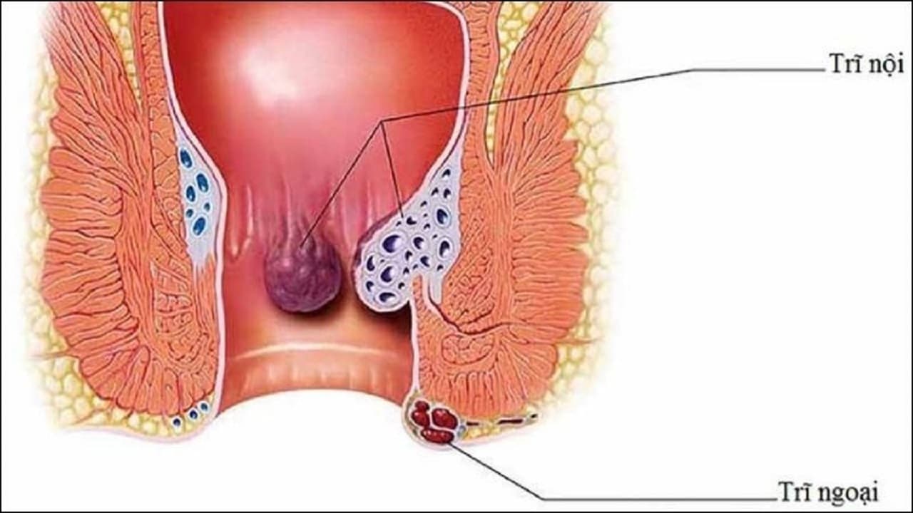 Nguyên nhân dẫn đến trĩ nội chủ yếu là do tình trạng tăng áp lực lên vùng chậu – hậu môn trong thời gian dài