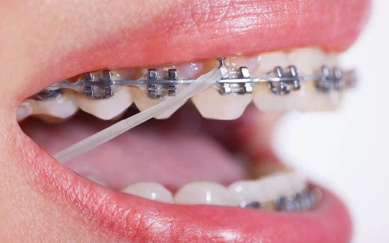 Liệu có nên niềng răng