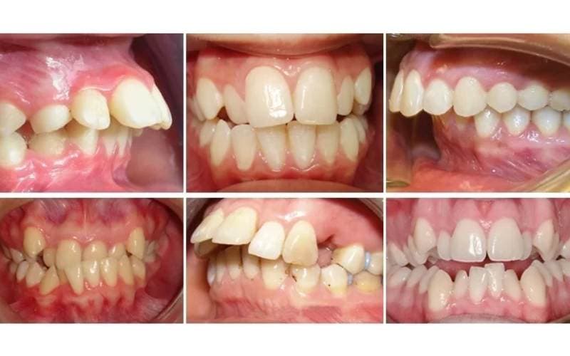 Có nên niềng răng mắc cài