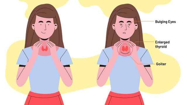 Cường giáp có nguy hiểm không và các trường hợp cần lưu ý