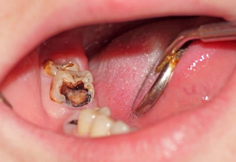 Khi xuất hiện dấu hiệu đau sâu răng, hãy nhanh chóng đến nha khoa để được điều trị, tránh nguy cơ nhiễm trùng lan rộng