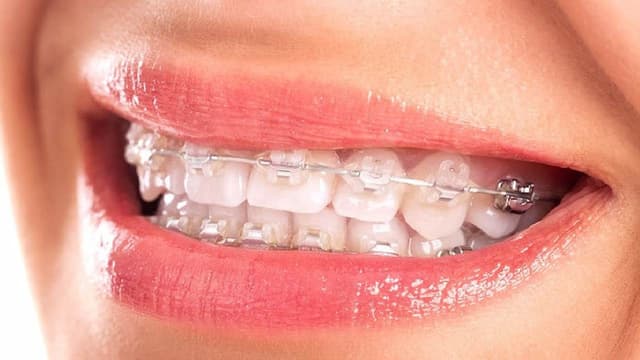 Đeo niềng răng trong bao lâu – Những điều cần chú ý