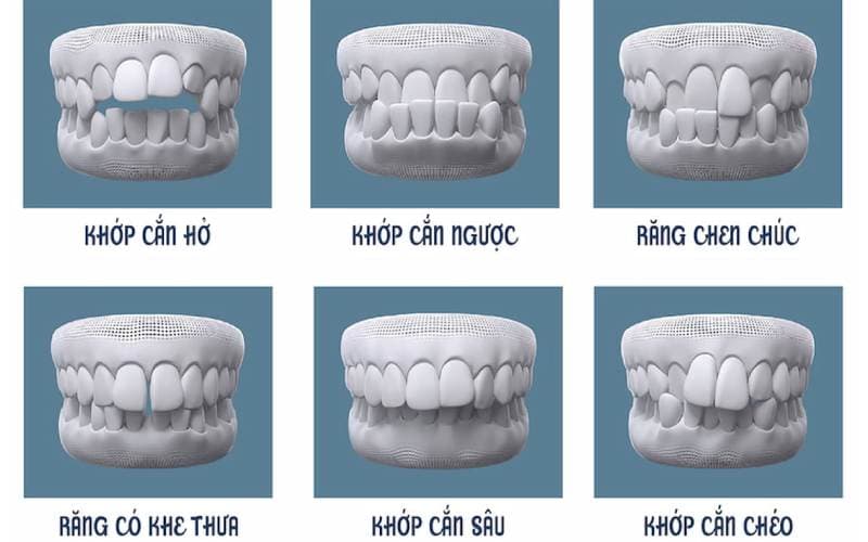 Thông thường Đeo niềng răng trong bao lâu