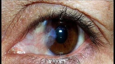 Tìm hiểu thông tin đầy đủ và điều trị mộng thịt ở mắt